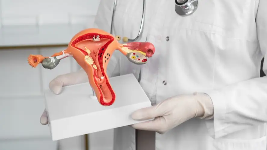 საკვერცხეების კისტა - გავრცელებული, მაგრამ მართვადი გინეკოლოგიური მდგომარეობა